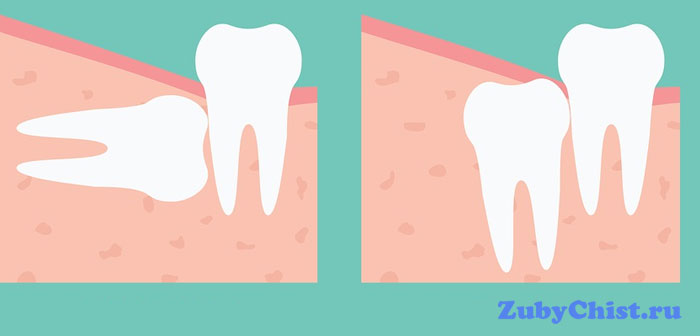 Зуб мудрости: расположение