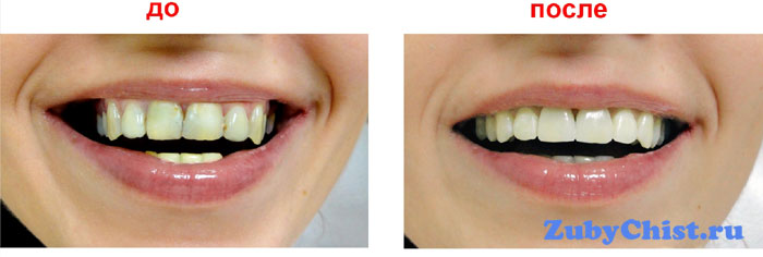 Реставрация зубов