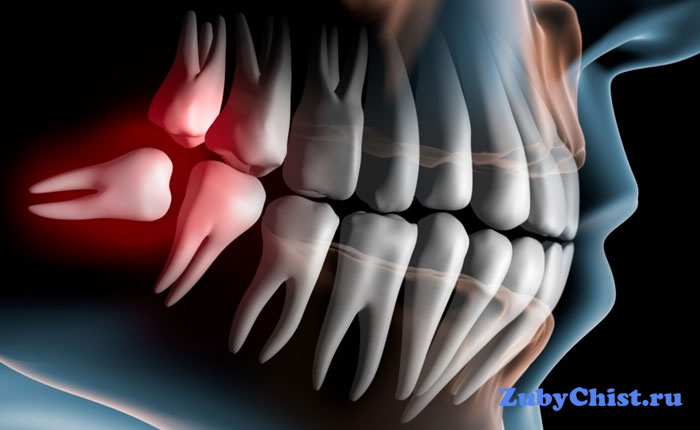 Ретинированный зуб
