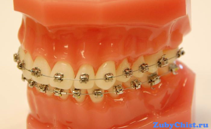 Самолигирующие брекеты