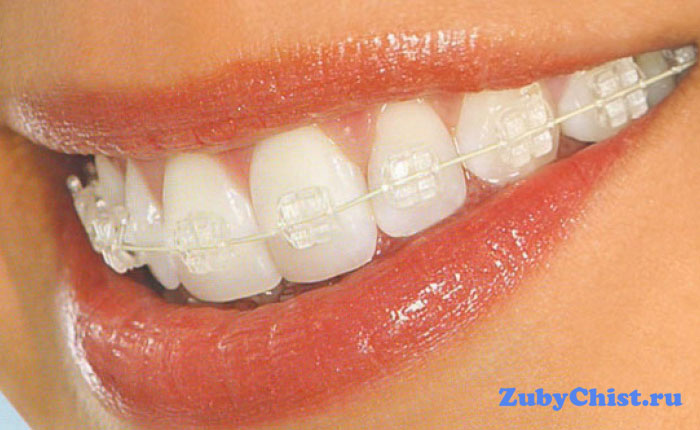 Сапфировые брекеты