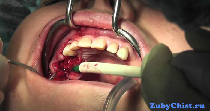 Проведение операции