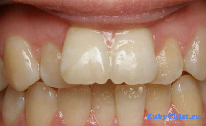 Скученность зубов