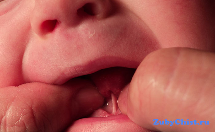 Уздечка языка у ребенка