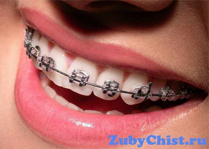 Девушка в брекетах для устранения диастемы