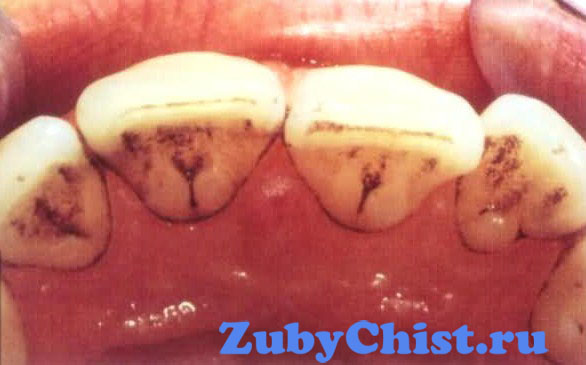 Межзубной кариес
