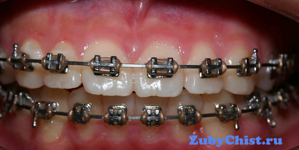 Брекеты для взрослого