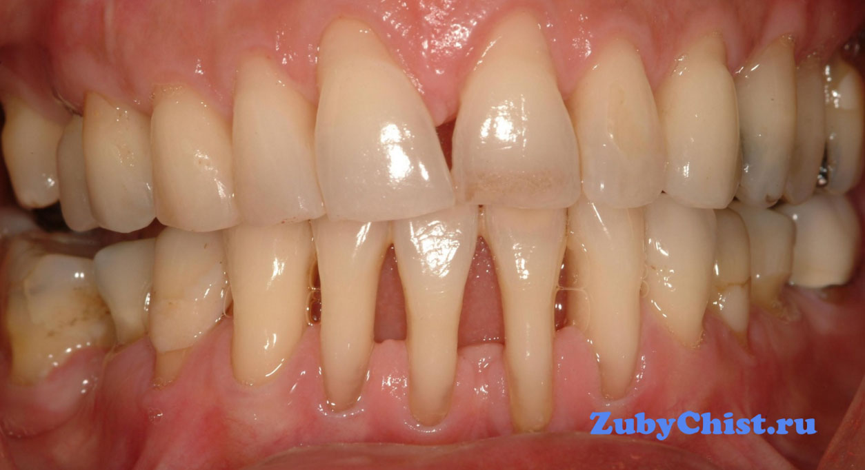 Атрофия десен