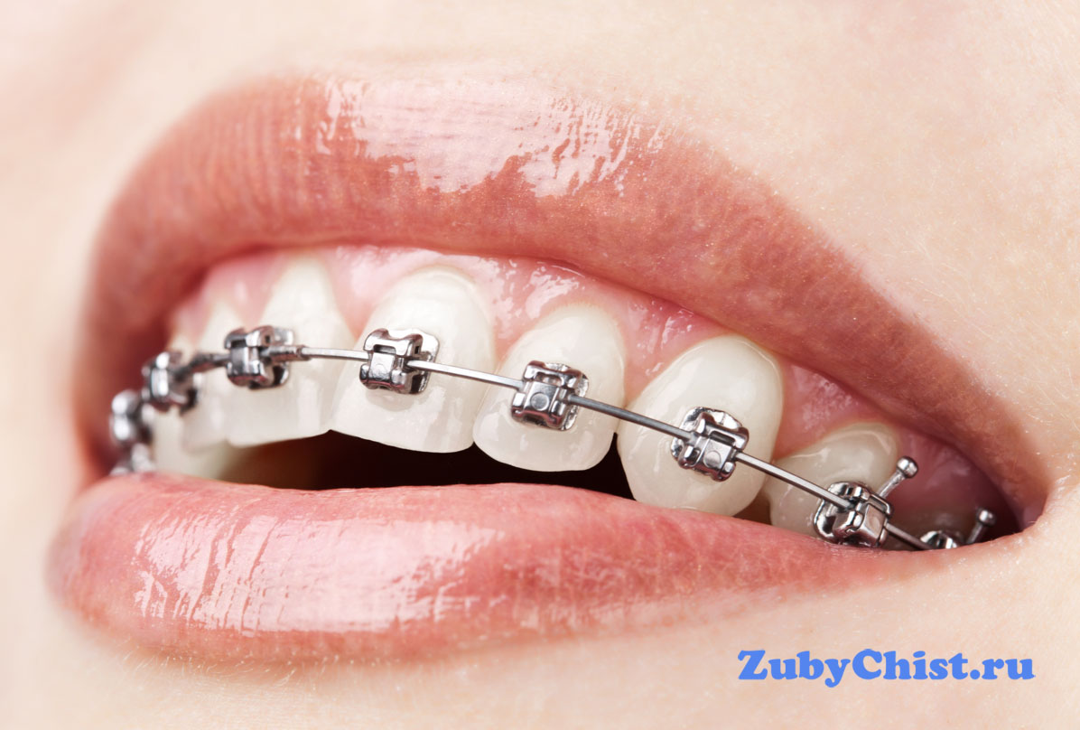 Брекет - система