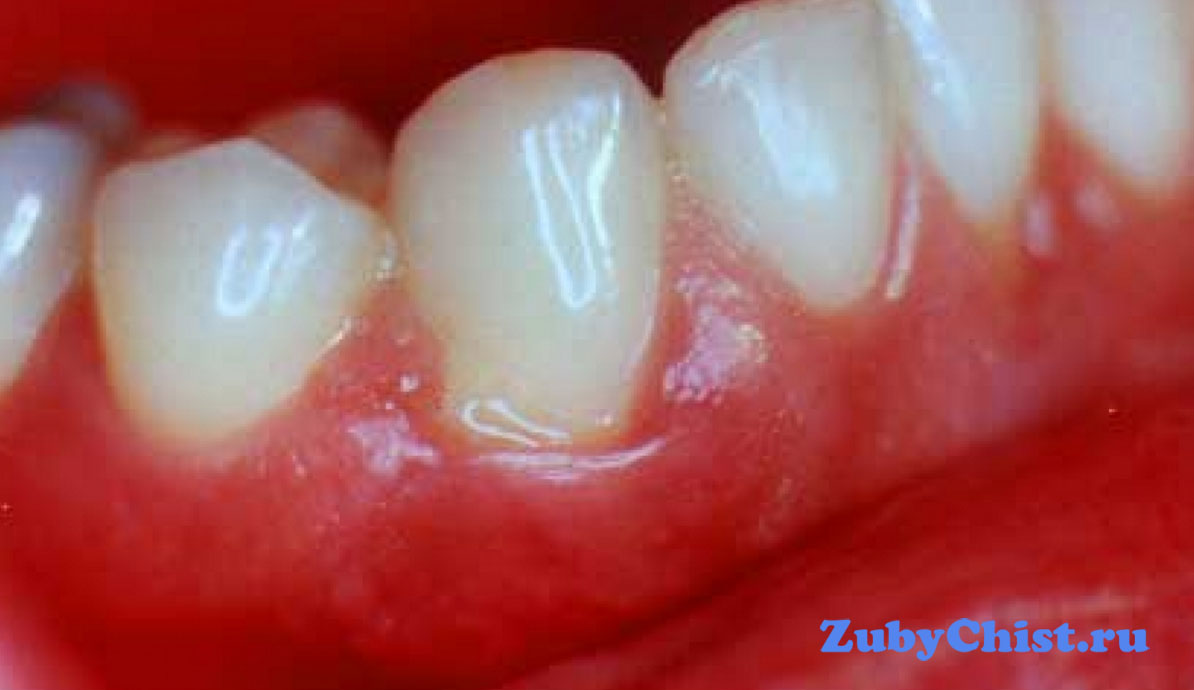 Воспаленная десна