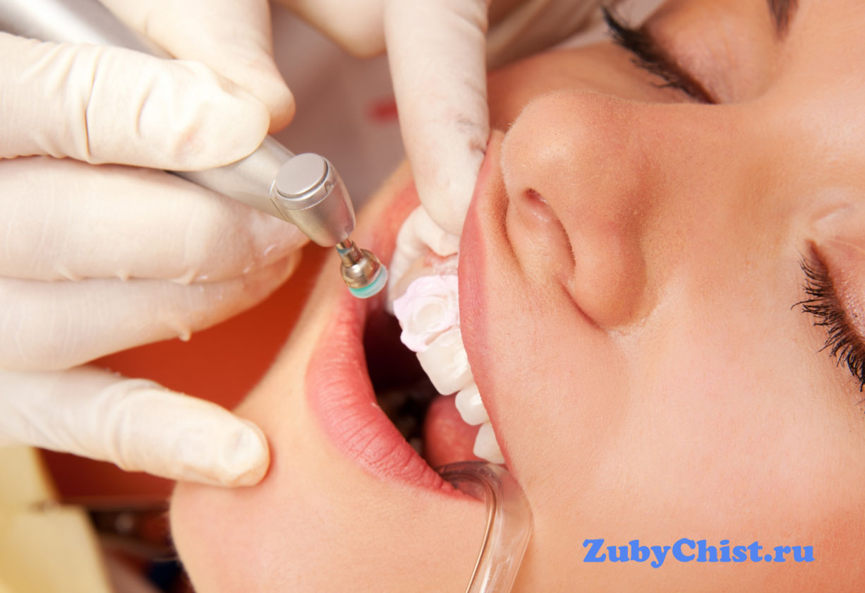 Полировка зубов