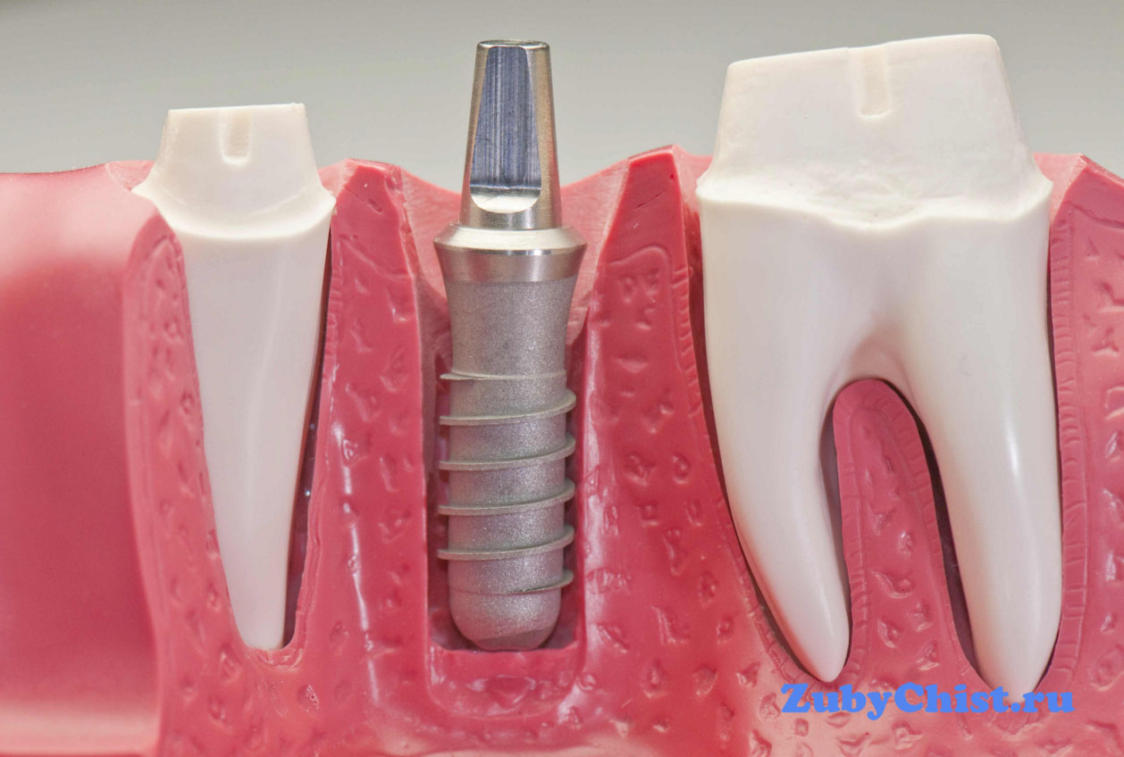 Тот самый мини имплант