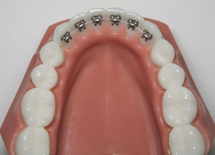 Лигатурные брекеты