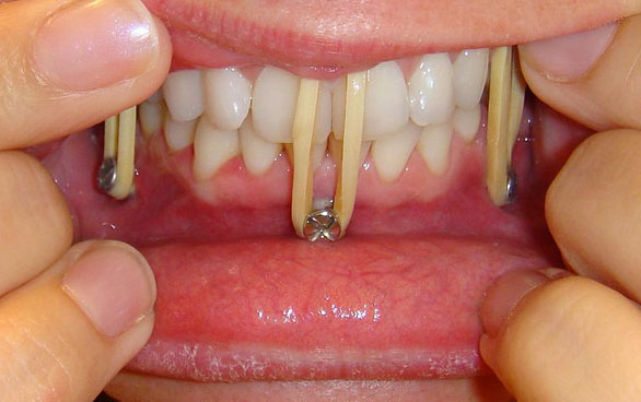 Шинирование зубов при переломе нижней челюсти