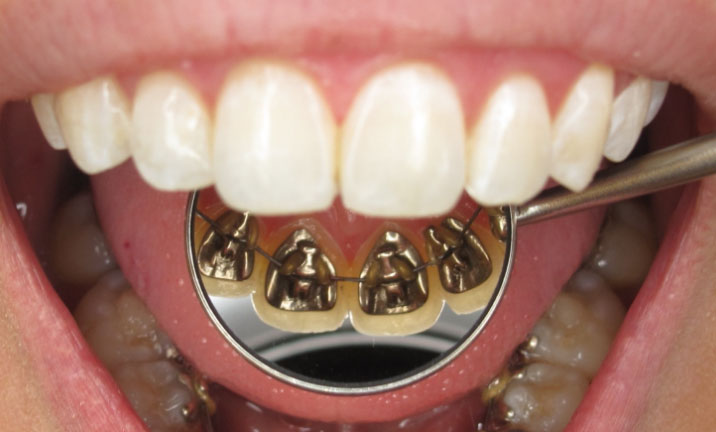 брекеты-неведимки