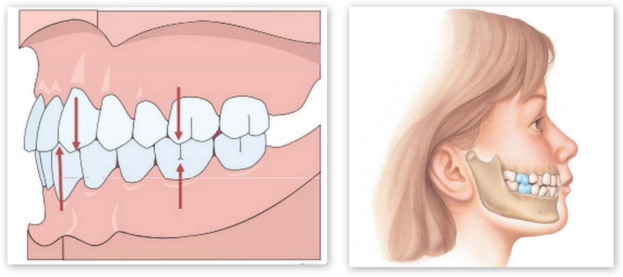 неправильный прикус зубов